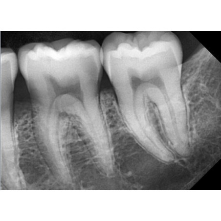 Paquete Radiovisiógrafo Ez Sensor Classic + Rayos X Dental Portátil Ez Ray Air Vatech