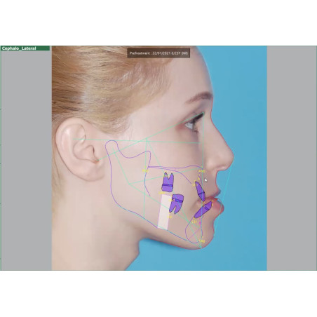 Software para Cefalometría Automática Ez Ortho Vatech