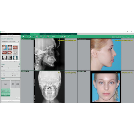 Software para Cefalometría Automática Ez Ortho Vatech