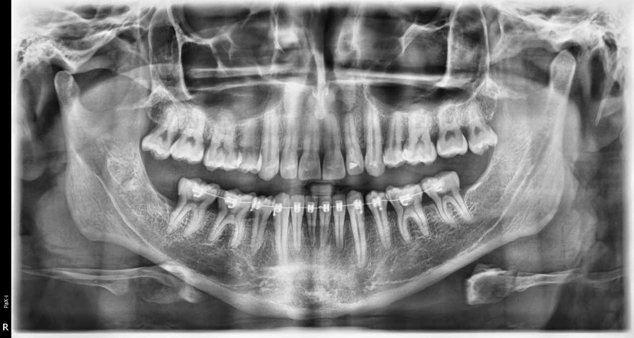 Ortopantomógrafo Vatech Pax i SC - Pano 1
