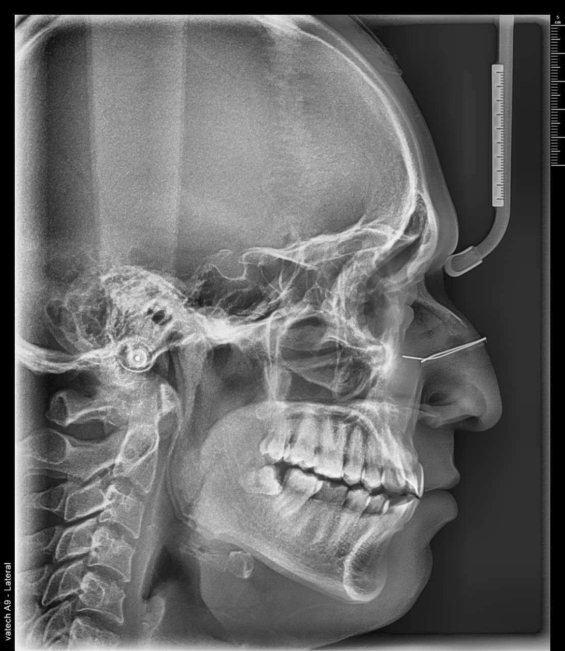 Rayos X 3D Cone Beam Vatech A9 - Radiografía Ceph