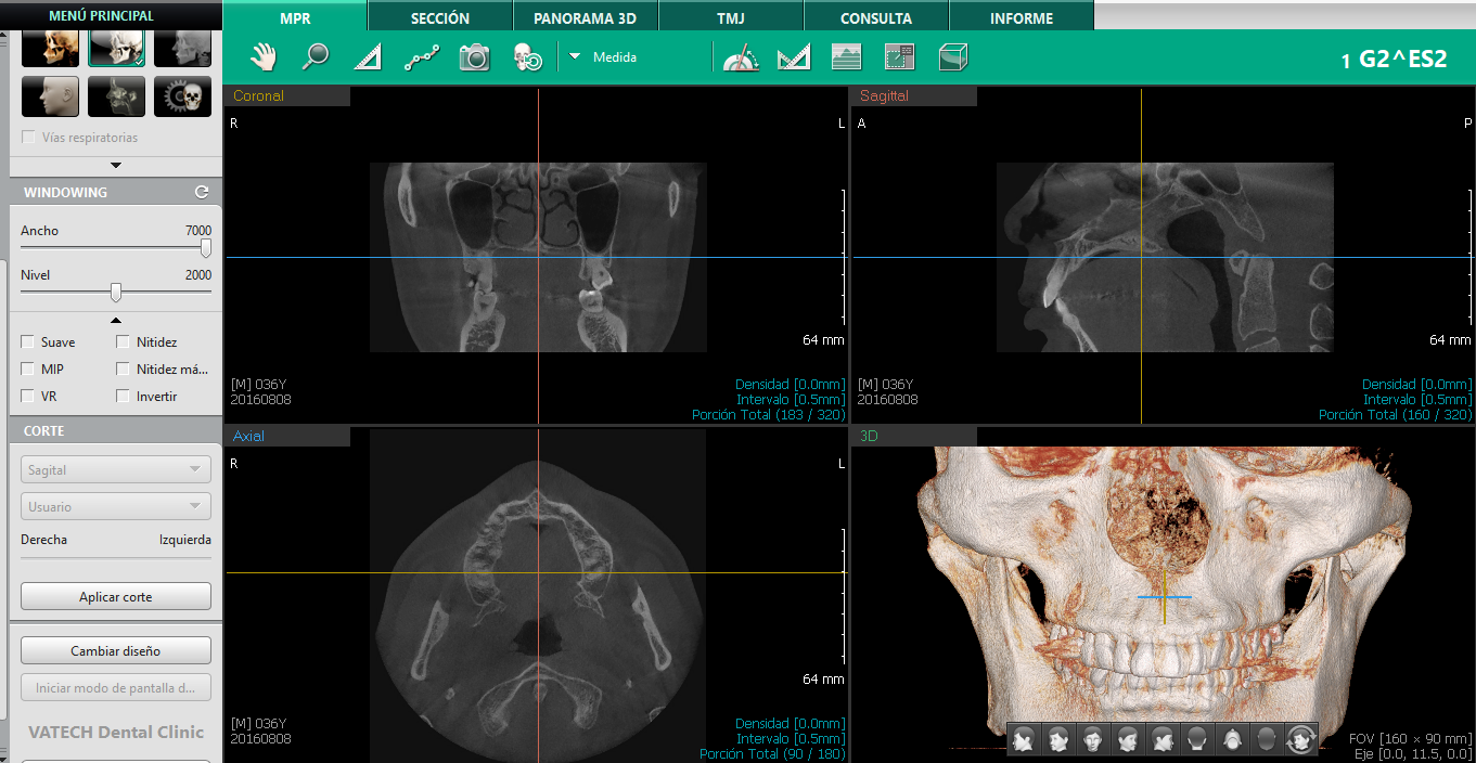 Tomógrafo Dental Vatech Green 16 SC - FOV 16 x 9