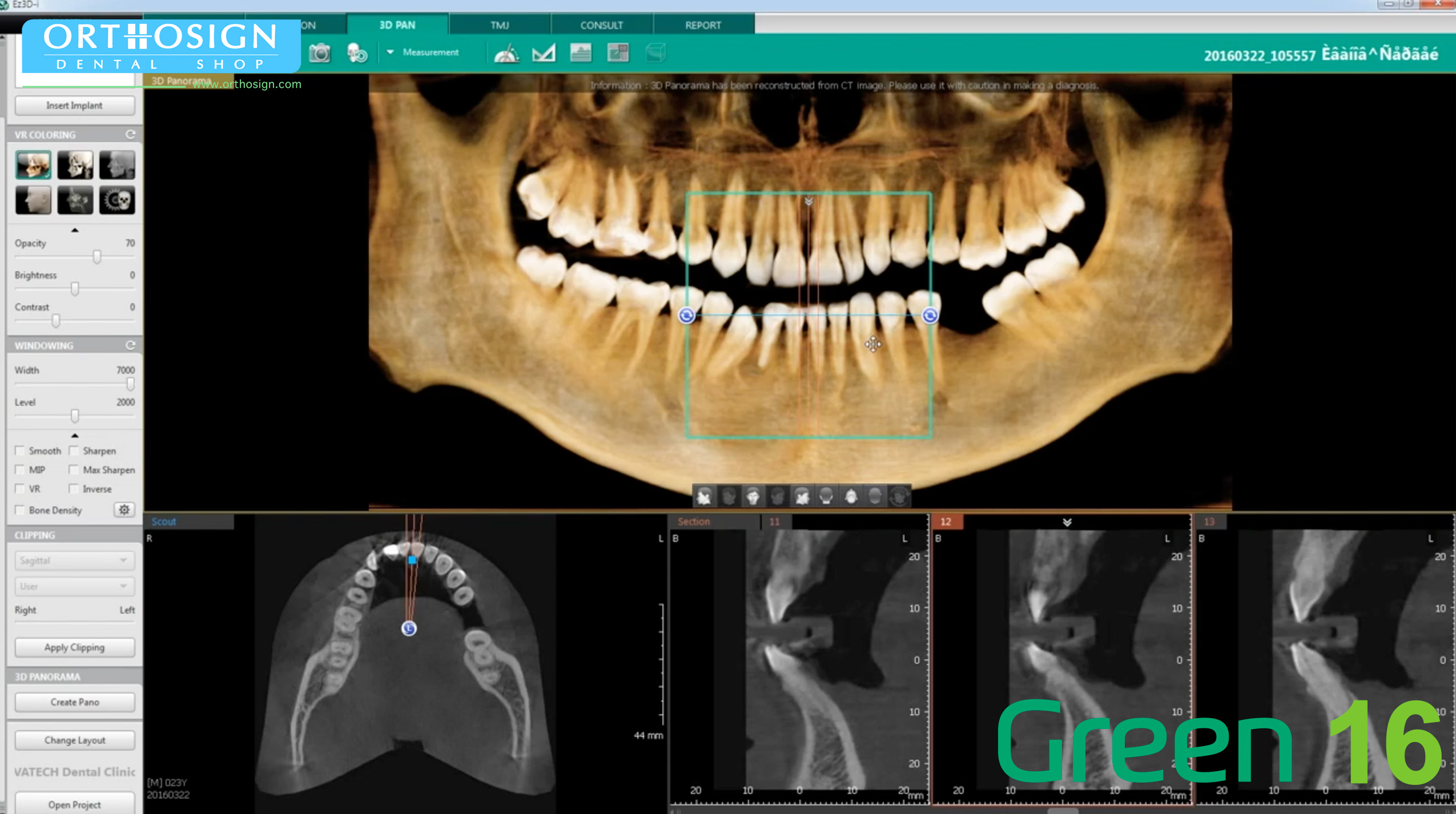 Tomógrafo Dental Vatech Green 16 SC - Panorámica 3D