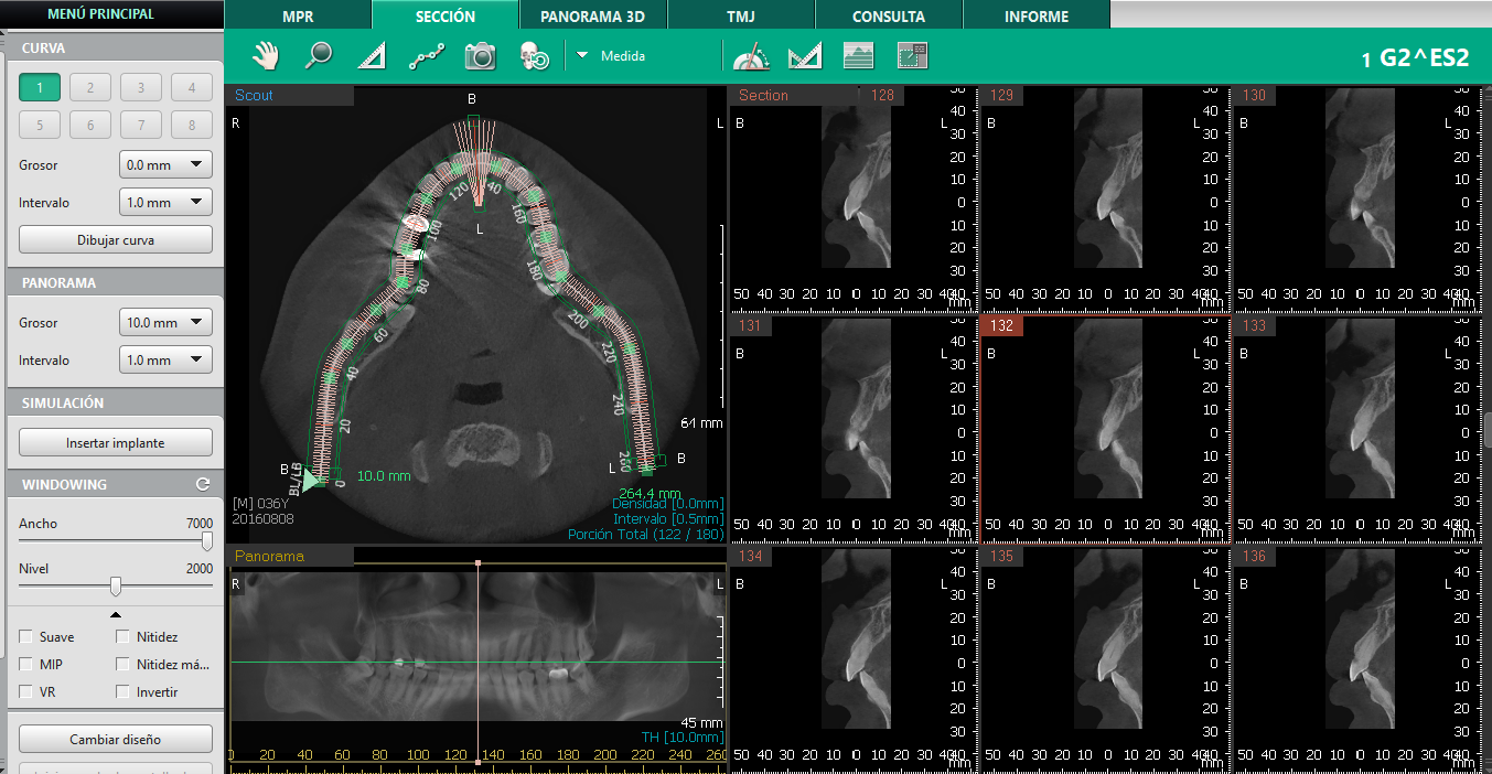 Tomógrafo Dental Vatech Green 16 SC - Seccional