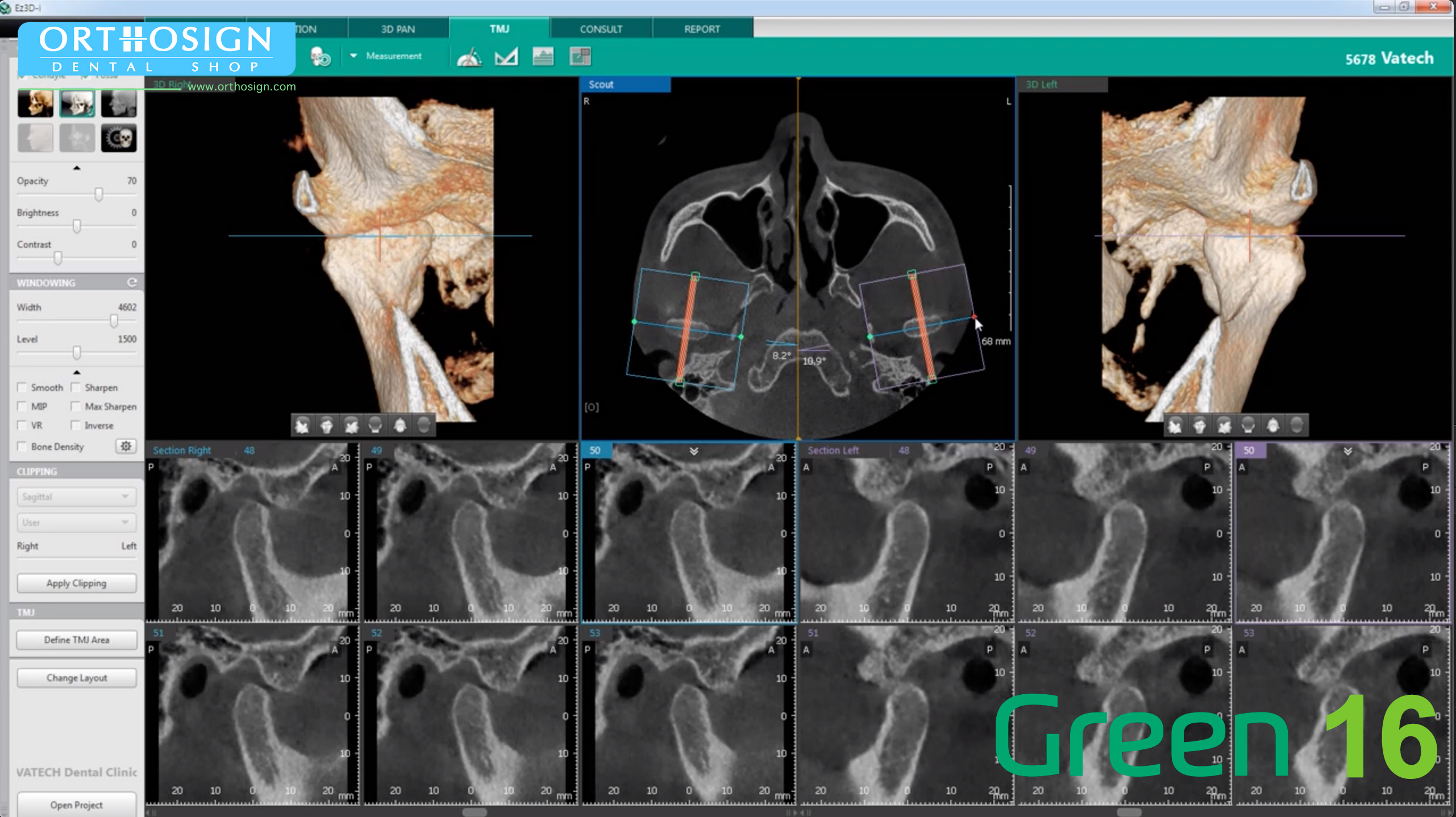 Tomógrafo Dental Vatech Green 16 SC - Análisis de ATM