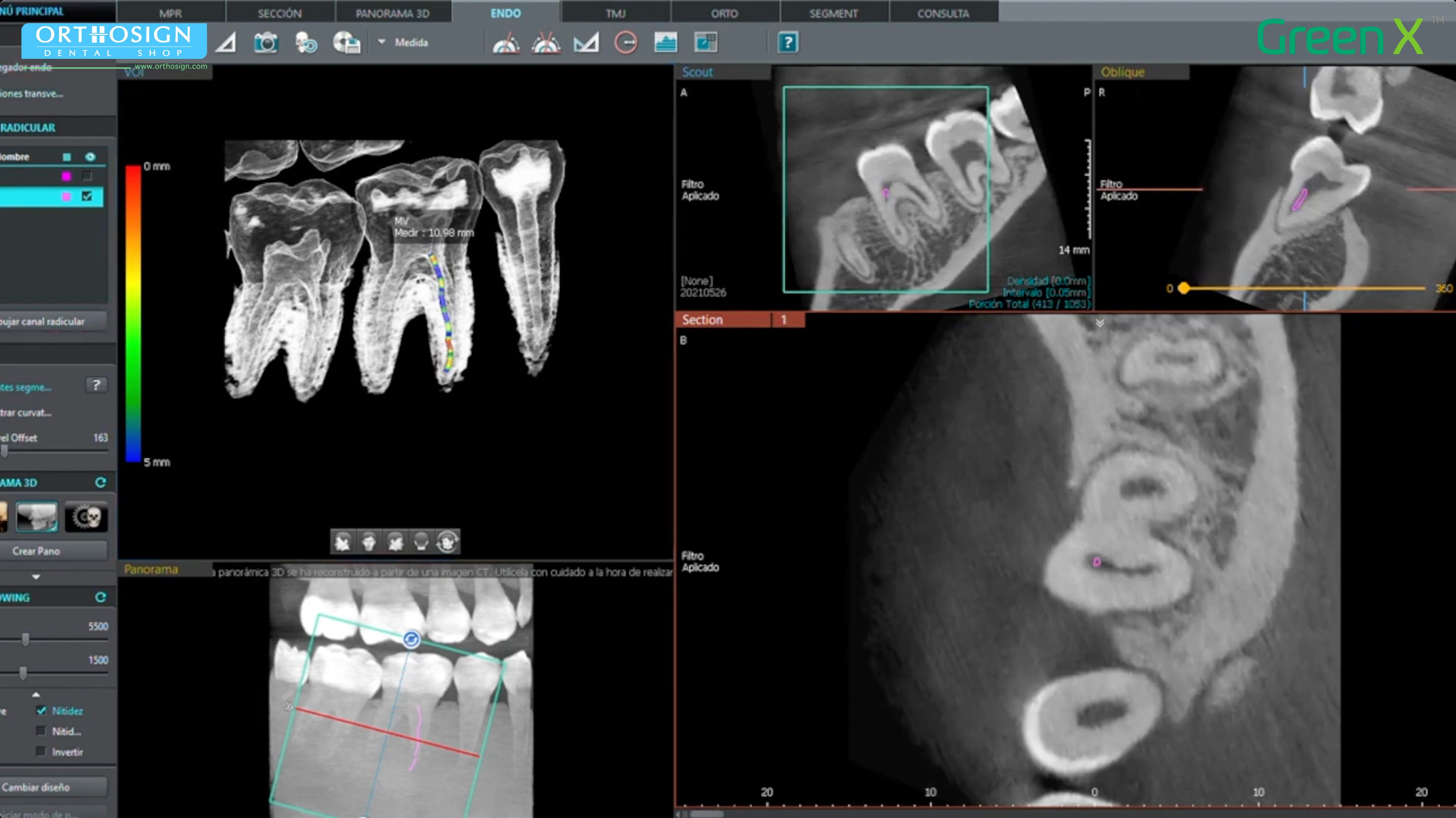 Tomógrafo Dental Vatech Green X16 - Modo ENDO