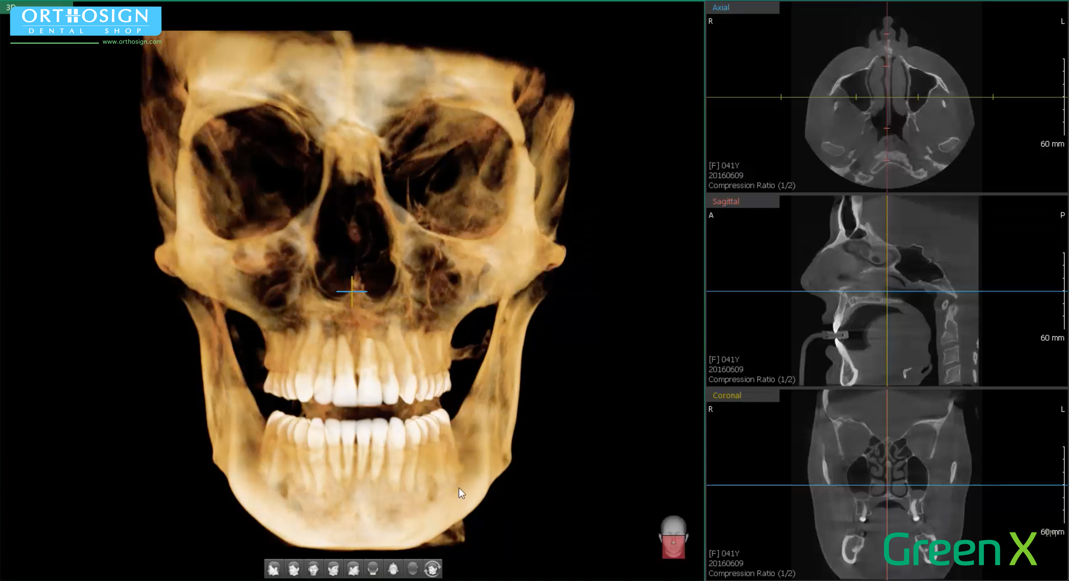 Tomógrafo Dental Vatech Green X16 - CT1