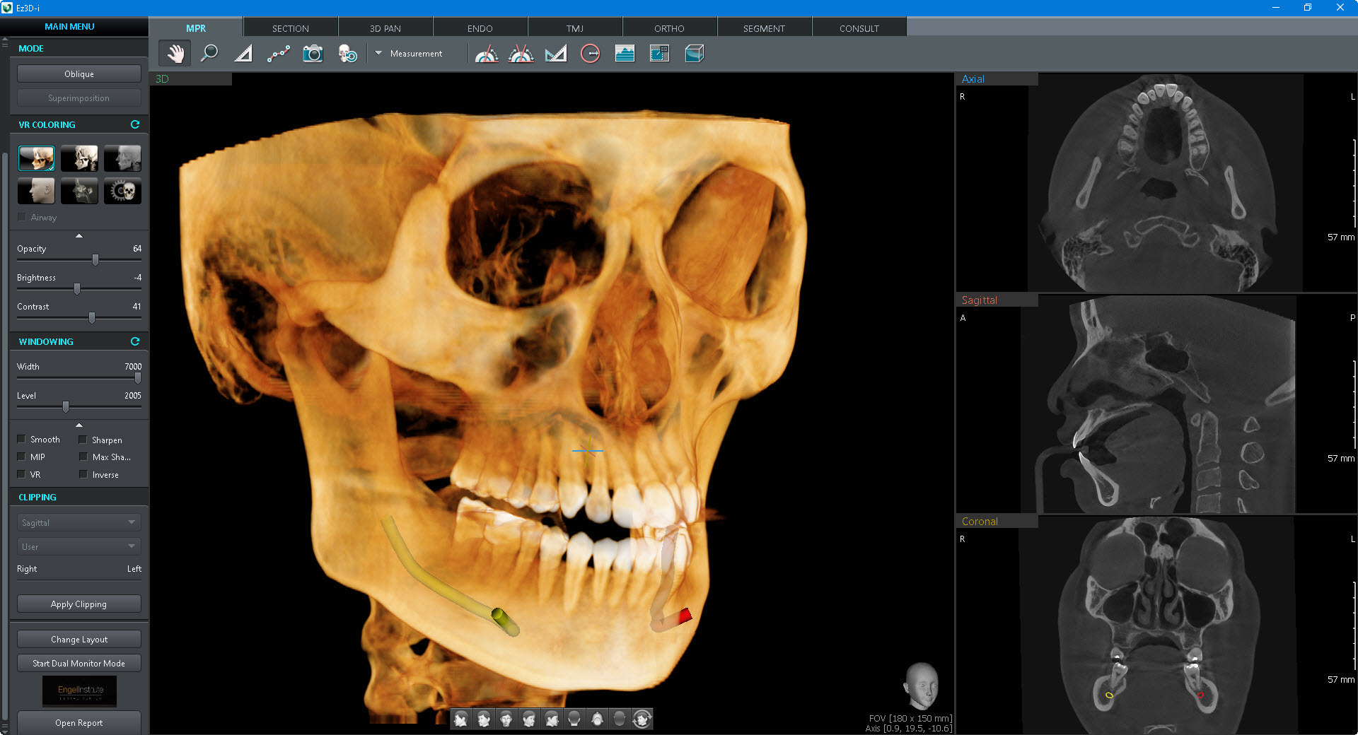 Tomógrafo Dental Vatech Green X18 - CT1