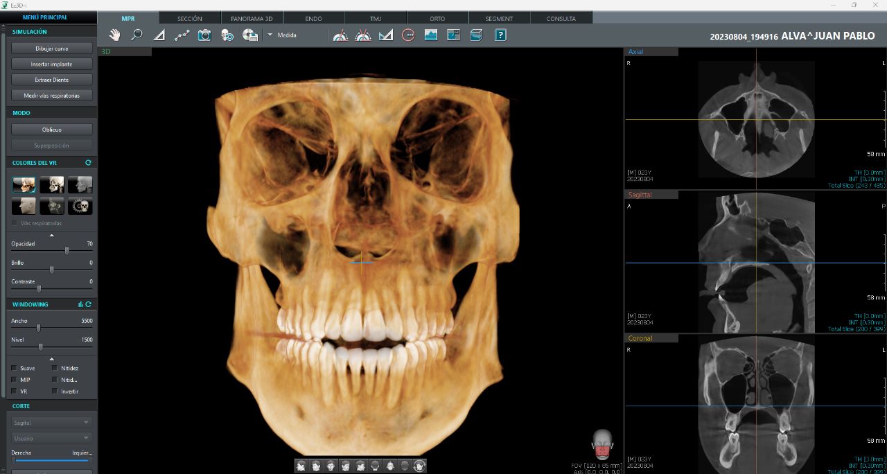 Tomógrafo Dental Vatech Green X12 - FOV 12 x 14 cm