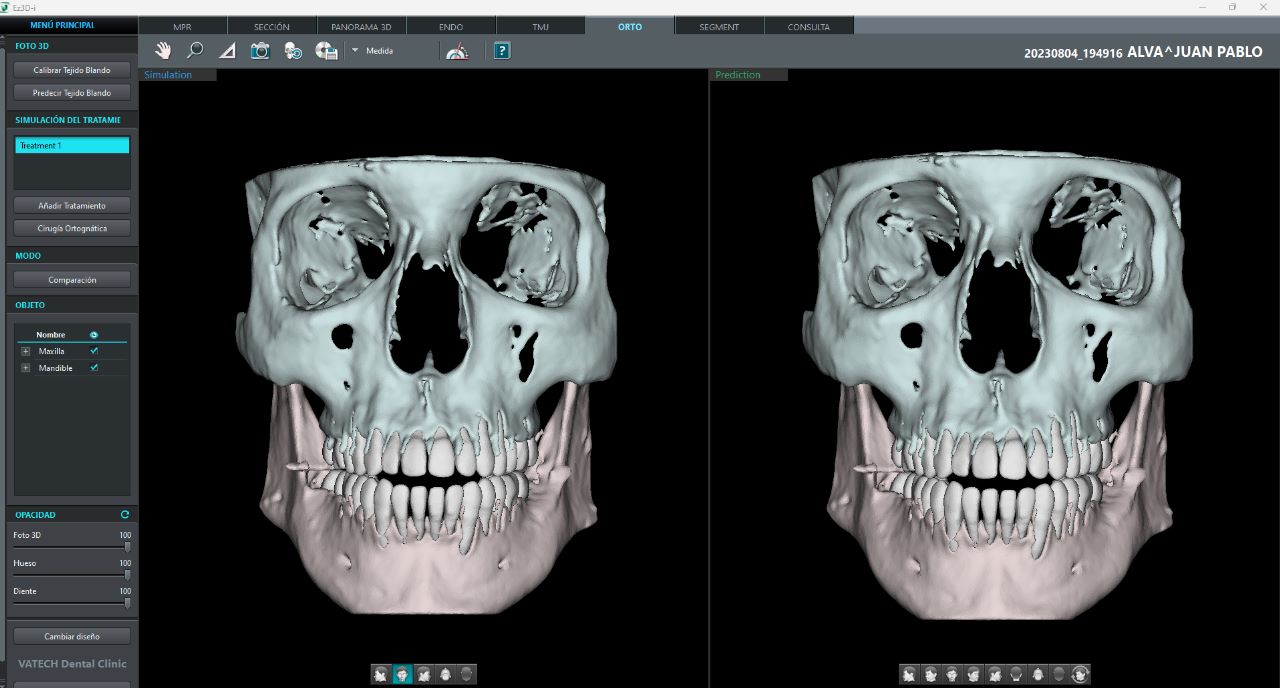 Tomógrafo Dental Vatech Green X12 -  FOV 12 x 14 cm