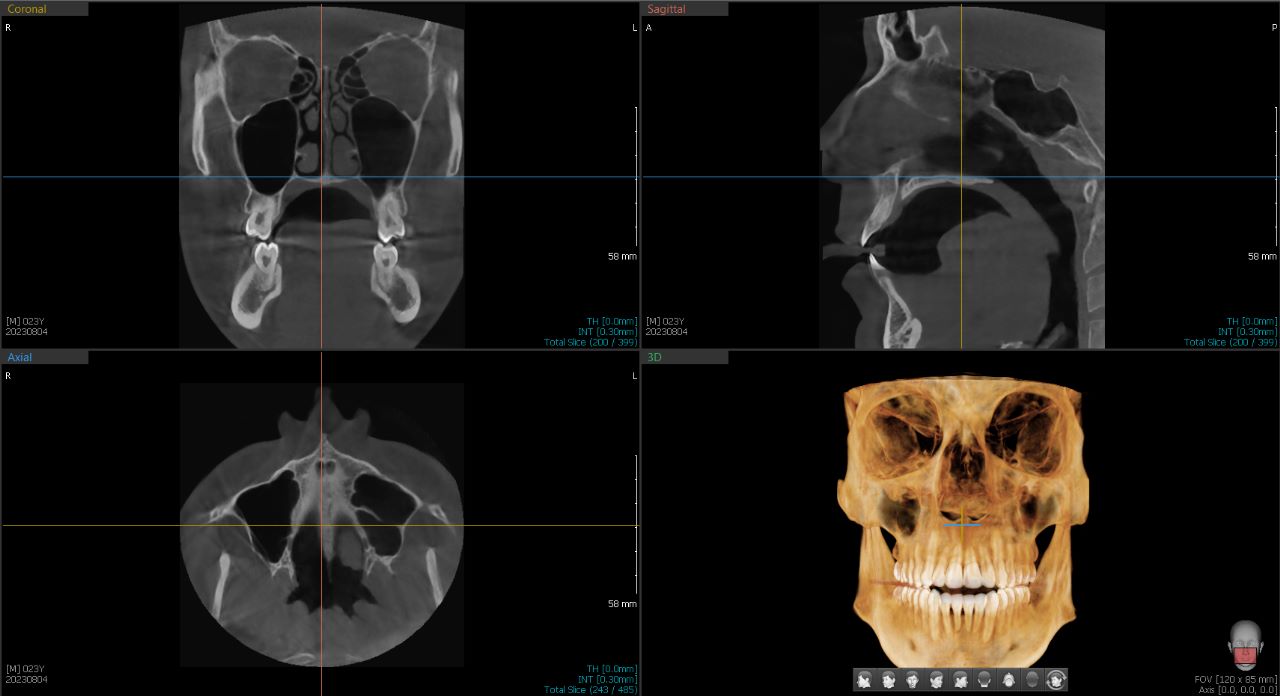 Tomógrafo Dental Vatech Green X12 - FOV 12 X 14 cm - 4