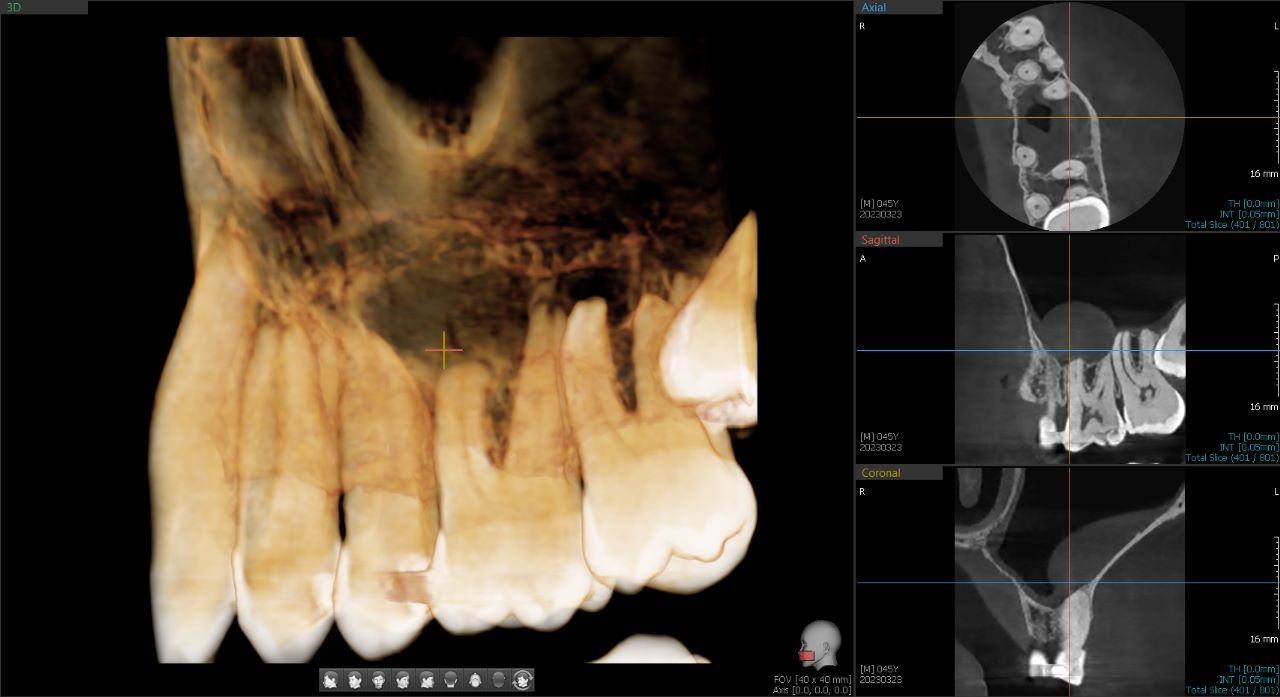 Tomógrafo Dental Vatech Green X12 - FOV 4 x 4 cm  - Vóxel .05 mm