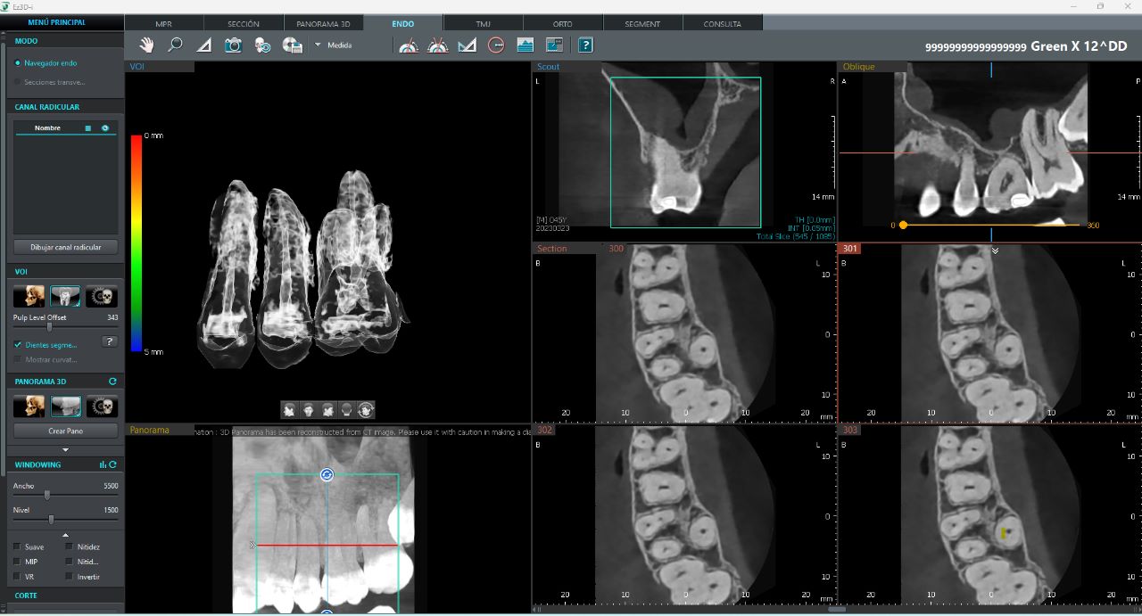 Tomógrafo Dental Vatech Green X12 - MODO ENDO