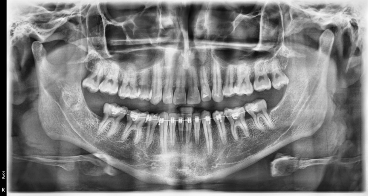 Rayos X Dental Panorámico + Ceph Pax i Plus - Vatech